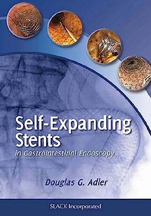 Self Expanding Stents in Gastrointestinal
