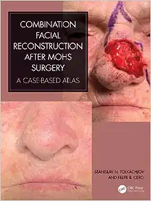 Combination Facial Reconstruction