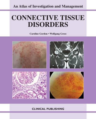 Connective Tissue Disorders